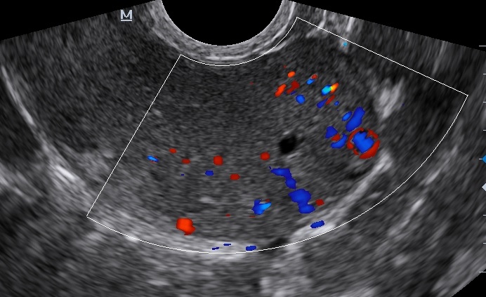 Рак Эндометрия На Узи Фото — Фото Картинки