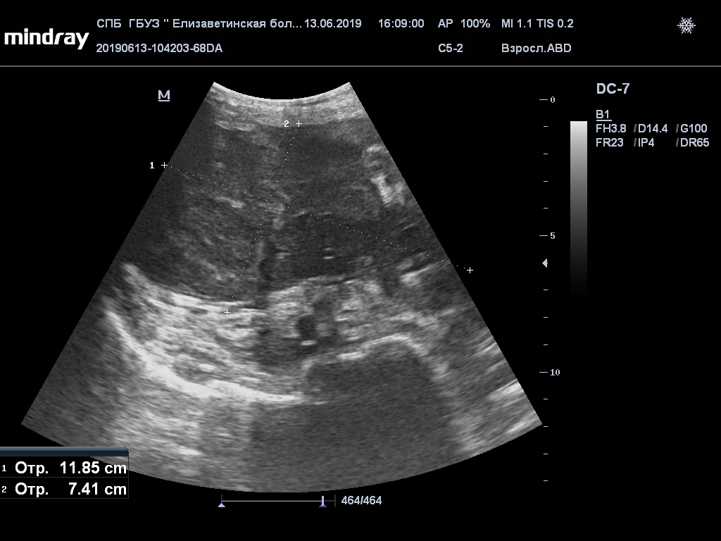 Узи кишечника взрослым. УЗИ кишечника при болезни крона. Болезнь крона на УЗИ кишечника. Конгломерат в брюшной полости.