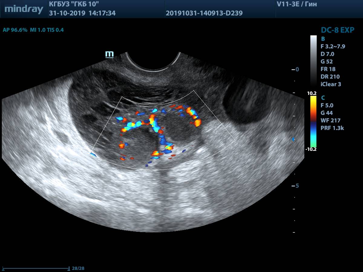 Узи образования. Тубоовариальный абсцесс УЗИ. Тубоовариальный абсцесс мрт. Тубоовариальный абсцесс кт.