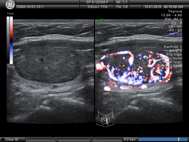 Ультразвуковое исследование паращитовидной железы. Паращитовидные железы на УЗИ. Сонограмма щитовидной железы. Аденома щитовидной железы на УЗИ. Сонография паращитовидных желез.
