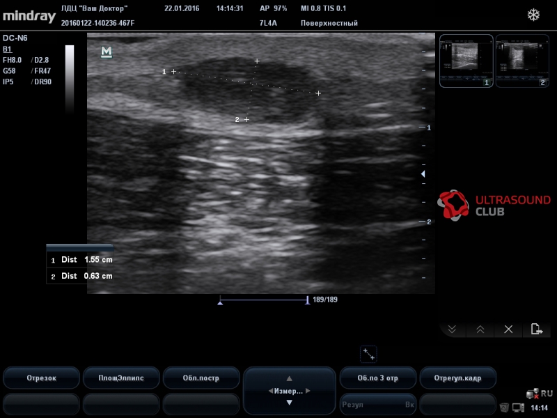 Липосаркома на узи фото мягких тканей