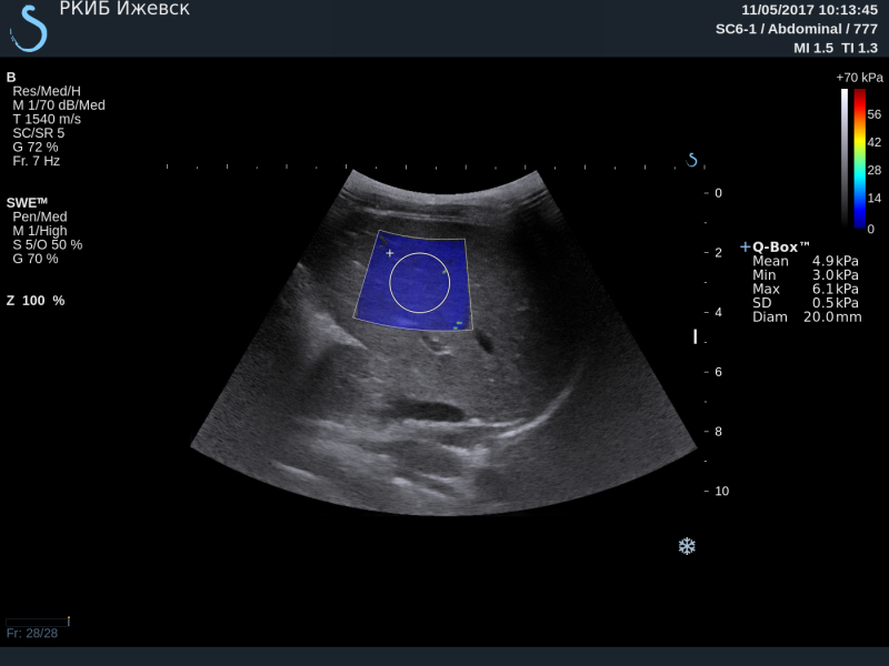 Эластография печени. Сдвиговая эластометрия печени. Ультразвуковая эластография сдвиговой волны точечная печени. Эластография паренхимы печени сдвиговой волной. Эластография печени 5-6 сегменте.