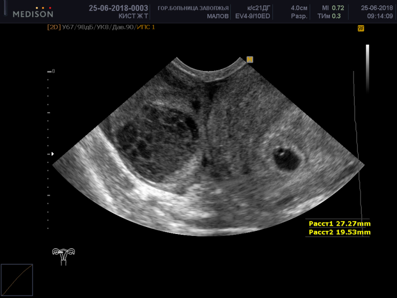 Киста желтого тела на узи фото узи