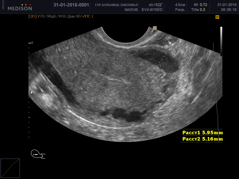 Запись на узи. Варикоз малого таза УЗИ. Расширение аркуатных вен матки. Варикозное расширение вен малого таза на УЗИ.