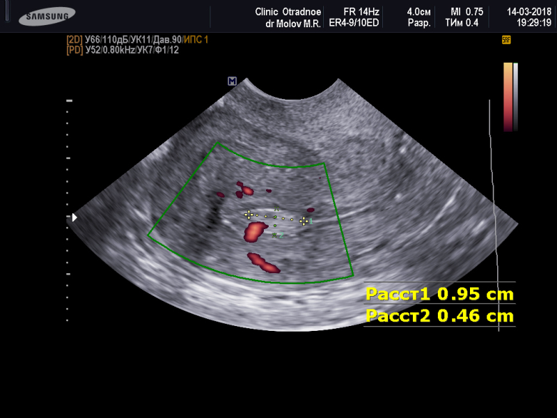 Полип эндометрия в матке на УЗИ.