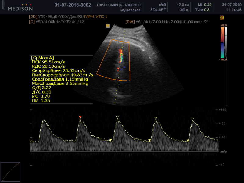 Доплерометрия. Допплерометрия средней мозговой артерии плода. Допплер СМА плода. Средняя мозговая артерия плода допплер. Кровоток в СМА.