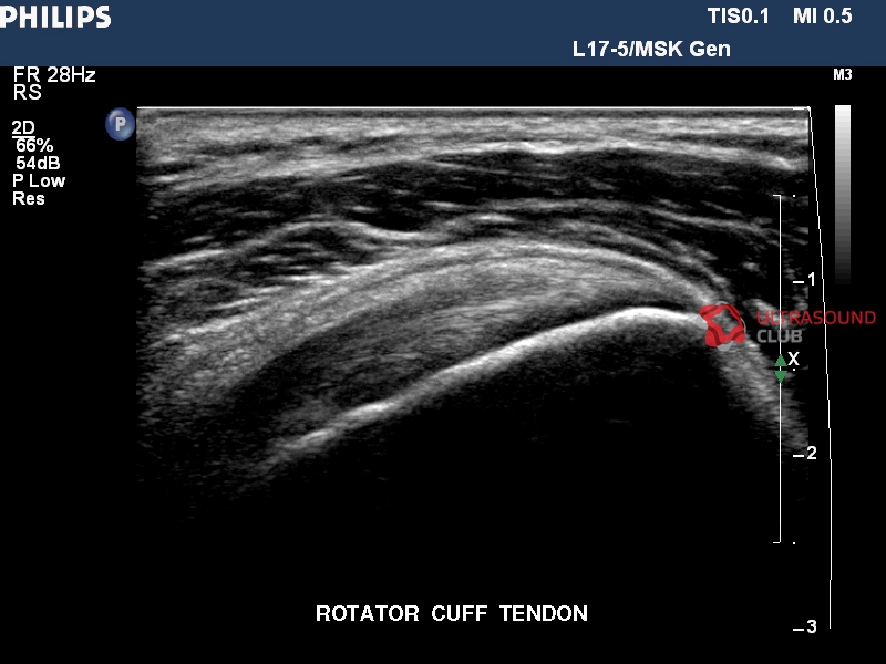 Узи плечевого. Разрыв двуглавой мышцы плеча на УЗИ. Тендиноз сухожилия надостной мышцы УЗИ. Тендинит сухожилия надостной мышцы плечевого сустава УЗИ. Разрыв сухожилия двуглавой мышцы плечевого сустава УЗИ.