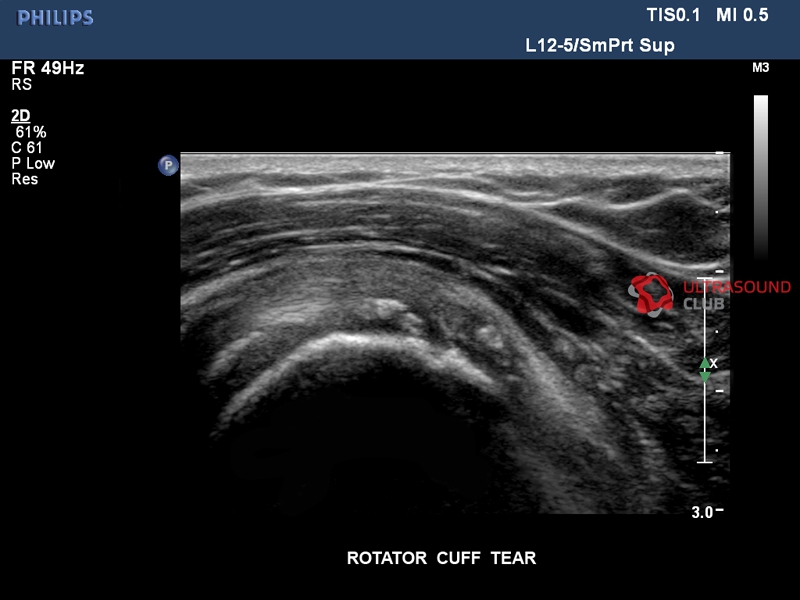 Узи плечевого. УЗИ тендинит вращательной манжеты. Ротаторная манжета УЗИ. УЗИ вращательная манжета плечевого. Вращательная манжета плеча на УЗИ.