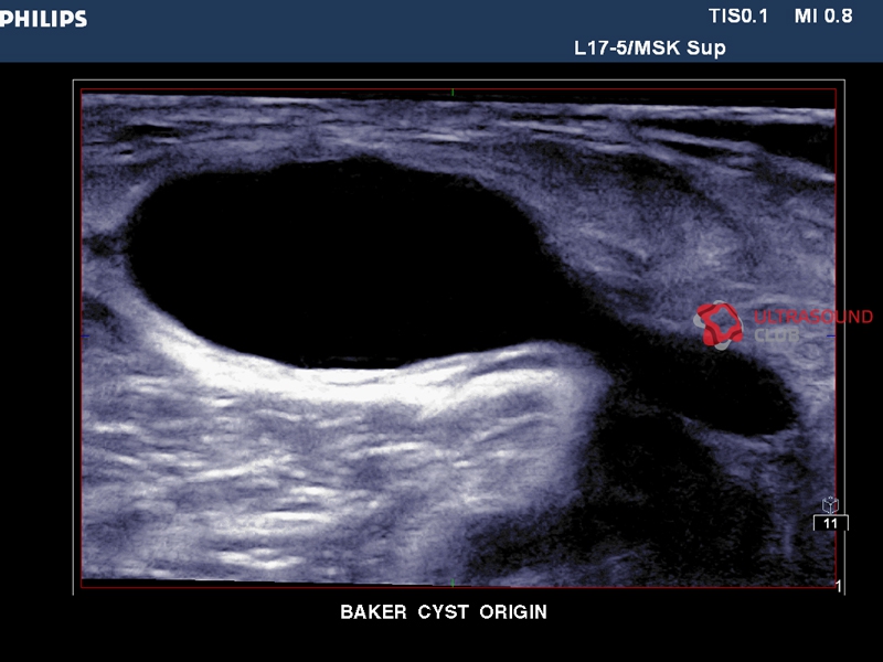 Киста бейкера на узи фото