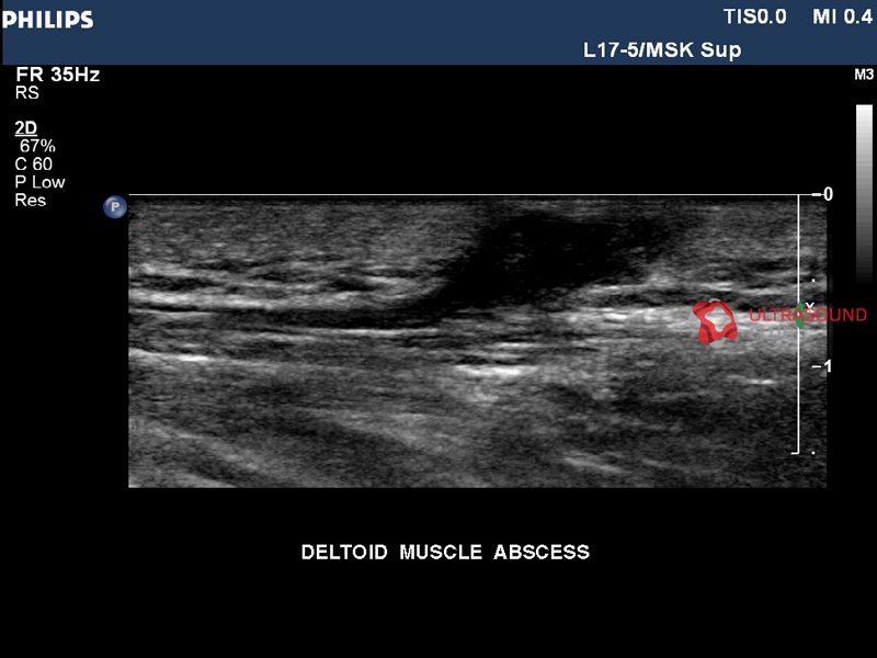Узи мышц. Дельтовидная мышца УЗИ.