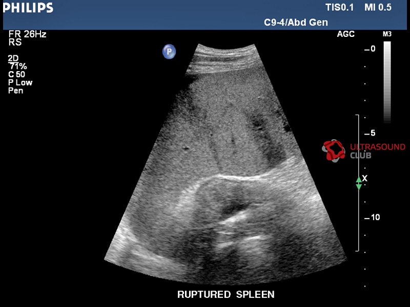 Узи селезенки. Подкапсульная гематома селезенки на УЗИ. Подкапсульный разрыв селезенки на УЗИ. Травмы селезенки УЗИ картина.