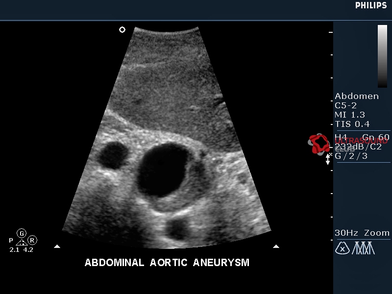 Аневризма аорты узи. Расслоение аневризмы брюшной аорты УЗИ. Аневризма брюшного отдела аорты на УЗИ. Расслаивающая аневризма аорты УЗИ картина. Аневризма аорты эхограмма.