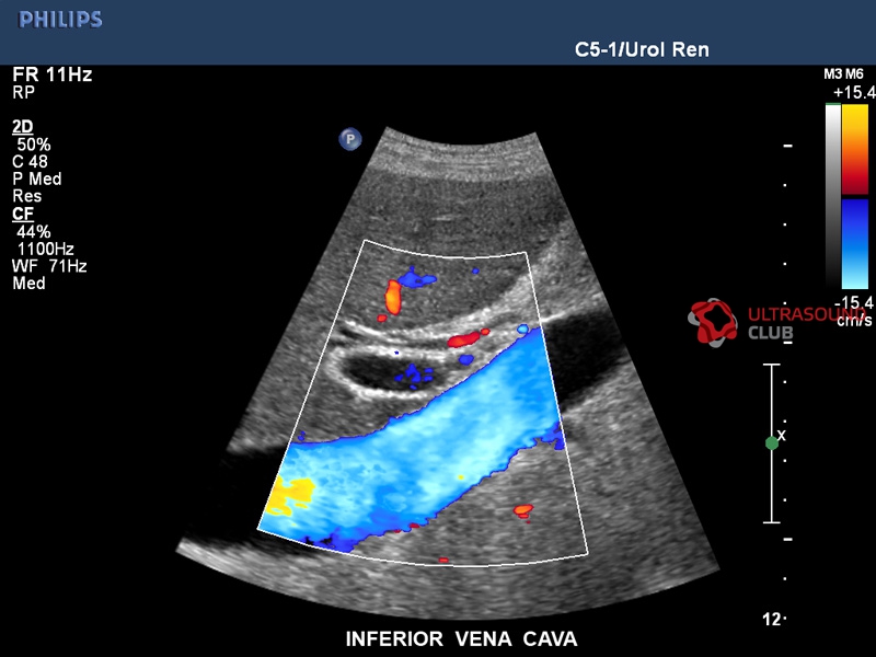 Узи см. Нижняя полая Вена норма на УЗИ. Ультразвуковая допплерография воротной вены. Допплерография нижней полой вены. Нижняя полая Вена на ЭХОКГ.