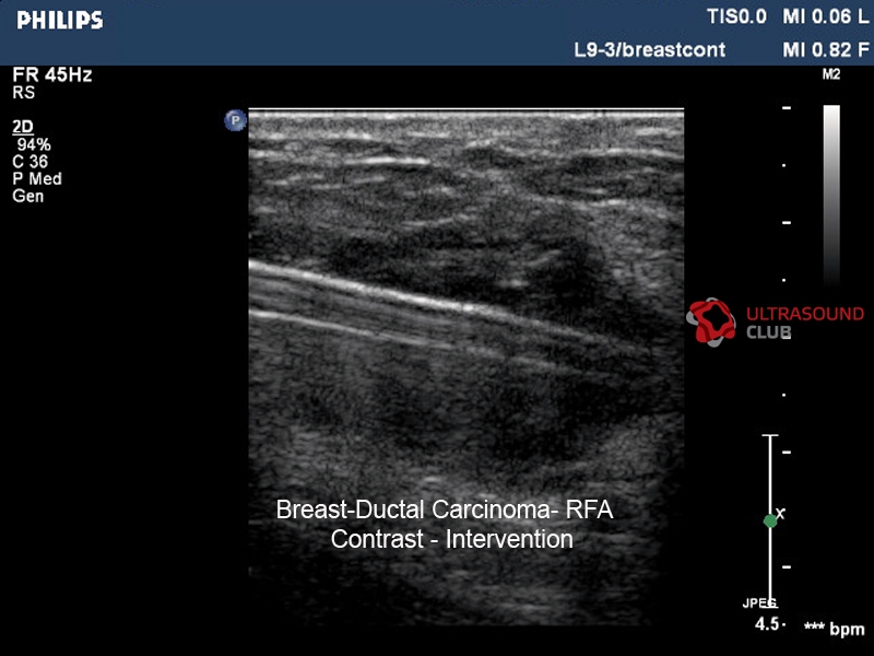 Папиллома молочной железы. Протоковая карцинома на УЗИ. Протоковая карцинома молочной железы на УЗИ. УЗИ картина внутрипротоковая папиллома молочной железы. Внутрипротоковые папилломы молочной железы на УЗИ.