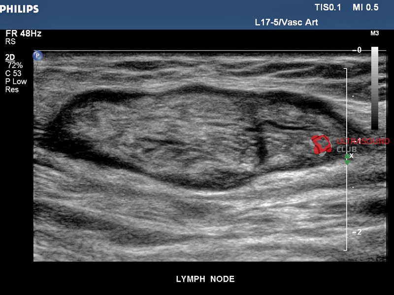 Узи лимфатических узлов паховые. Лимфаденит УЗИ лимфоузлов. Метастазы лимфоузлов на УЗИ. УЗИ паховых лимфоузлов.