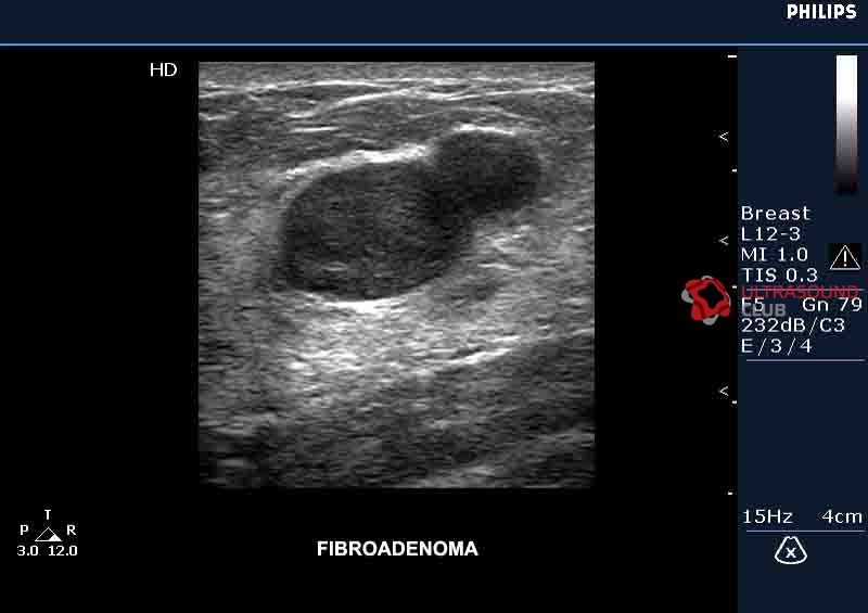 Фиброаденома молочной железы фото на узи как выглядит