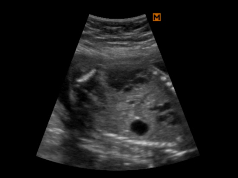 Анэхогенное образование. Энохогенное образование в брюшной полости у плода. Анэхогенное образование в брюшной полости у плода. Киста брюшной полости у плода. Объемные аперистальтические образования в брюшной полости.