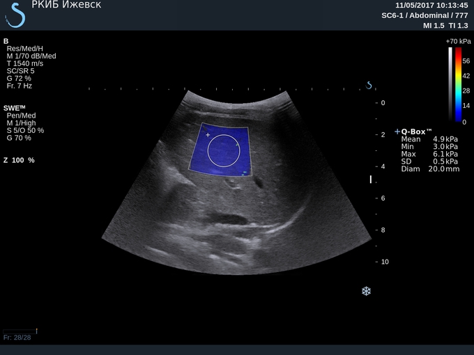 Эластография печени фото