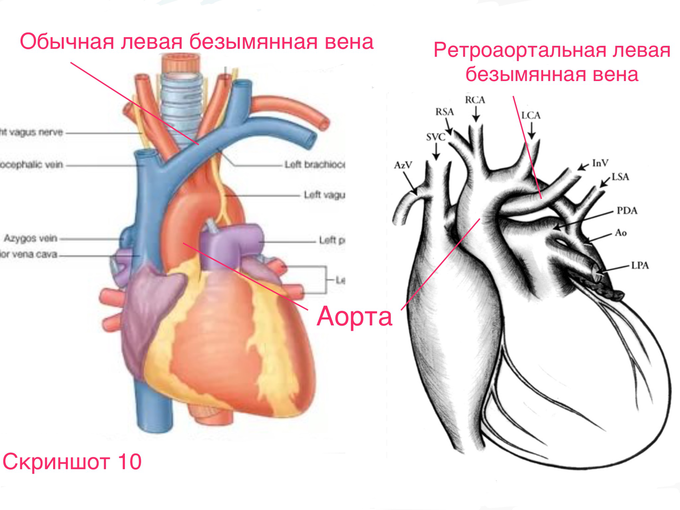 В верхней полой вене есть полулунные клапаны