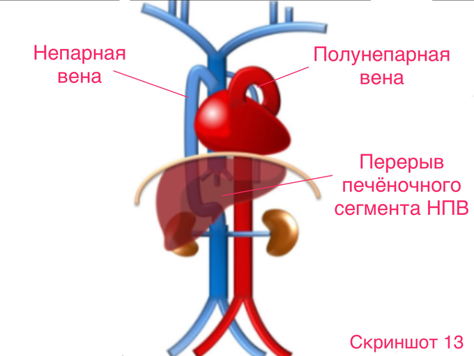 В верхней полой вене есть полулунные клапаны